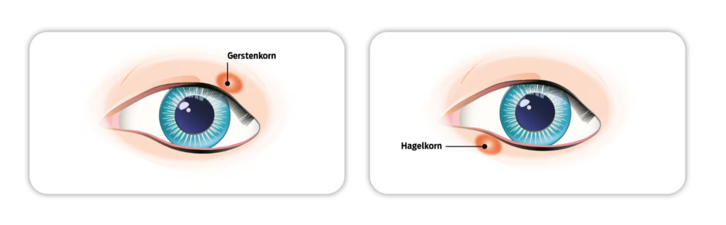 Gerstenkorn und Hagelkorn (Bild: © Similasan Österreich)