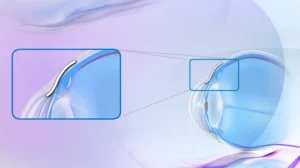 Hoffnungsträger beim Grünen Star: Wie der XEN Stent den Augeninnendruck senken soll