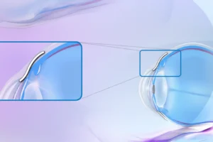 Hoffnungsträger beim Grünen Star: Wie der XEN Stent den Augeninnendruck senken soll