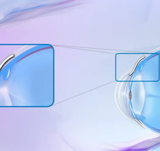 Hoffnungsträger beim Grünen Star: Wie der XEN Stent den Augeninnendruck senken soll