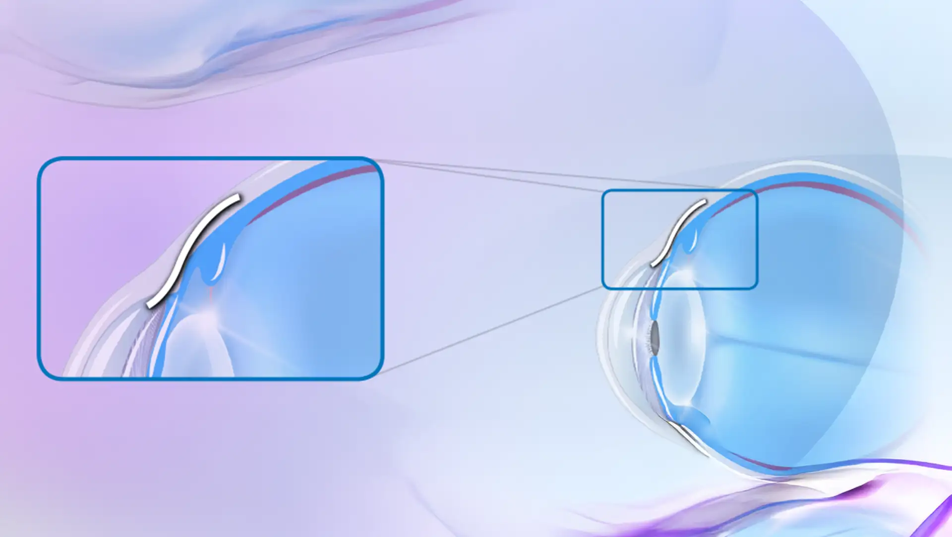 Hoffnungsträger beim Grünen Star: Wie der XEN Stent den Augeninnendruck senken soll