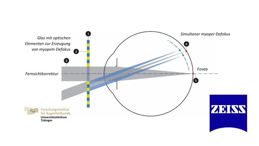 Myopie im Fokus ZEISS Vision Science Lab liefert neue Erkenntnisse zur Entstehung von Kurzsichtigkeit