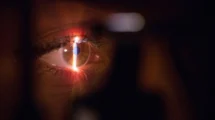 Netzhautveränderungen liefern Hinweise auf genetisches Schizophrenie-Risiko