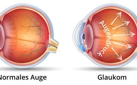 Vergleich normales Auge & Glaukom (Bild: © OCUVITE / Bausch + Lomb GmbH)