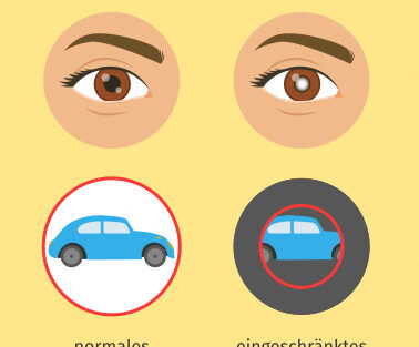 Vergleich Gesichtsfeld (Bild: © Sofatutor)