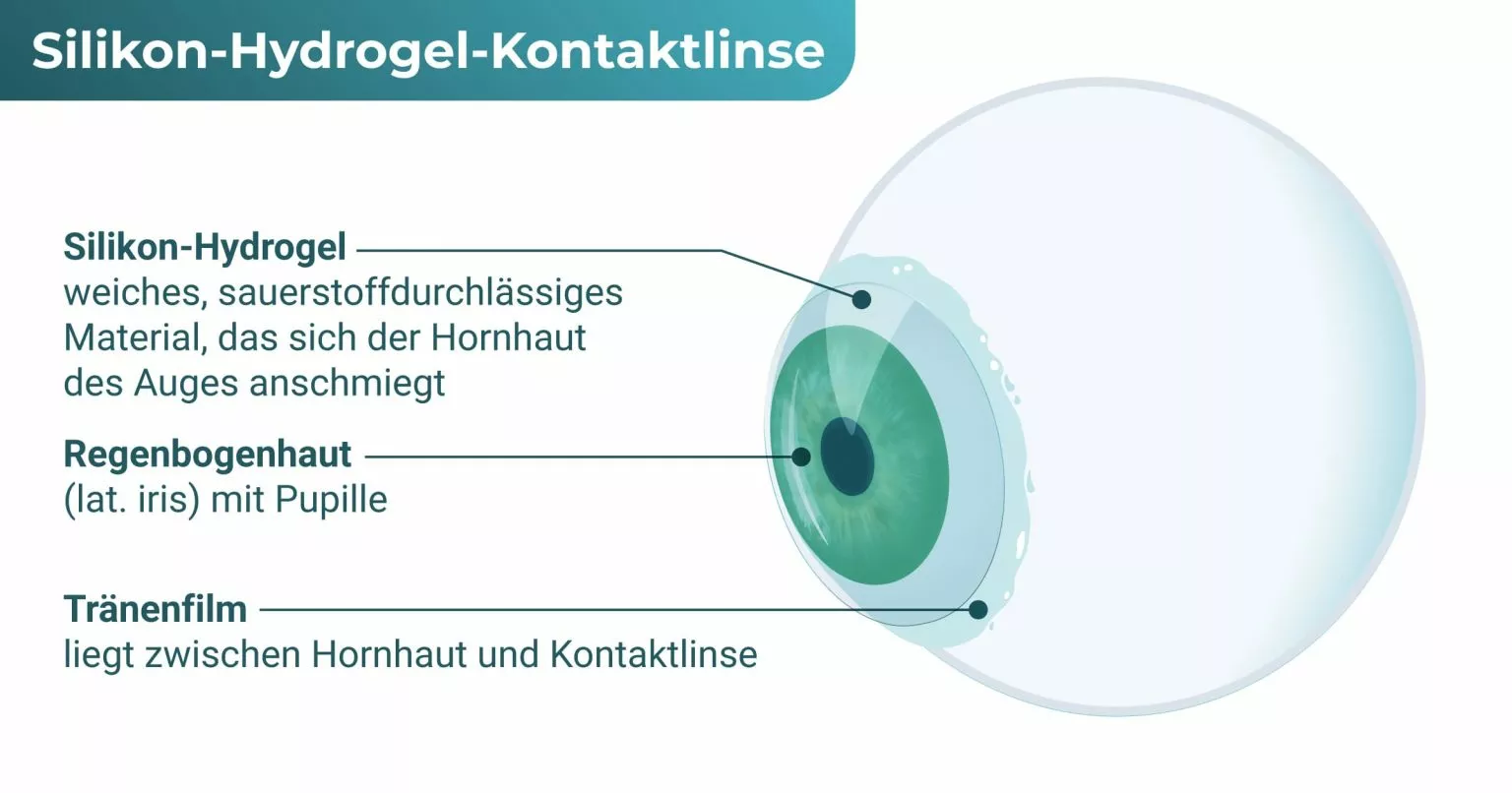Silikonhydrogel-Kontaktlinsen (Quelle: © Kontaktlinseninfo.de)